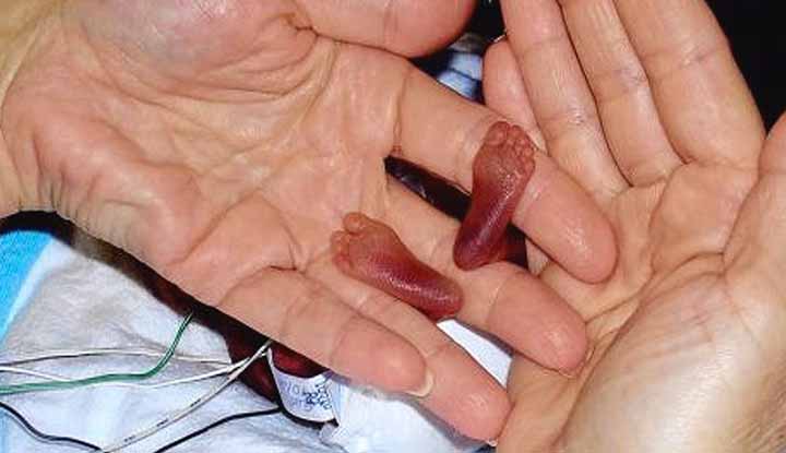 Este feto de 21 semanas estava condenado à morte! Mas o que aconteceu surpreendeu os médicos!