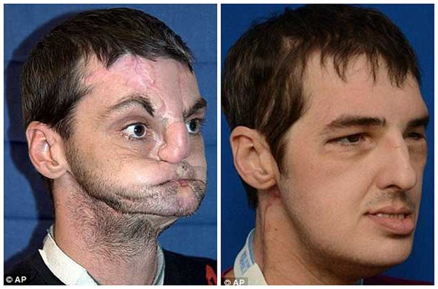 Família doou o rosto do falecido filho para transplante… Eles emocionaram-se ao rever o seu rosto…