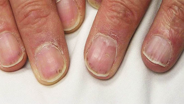 As unhas podem estar a avisar-te de alguma doença que tenhas! Conhece os sinais!