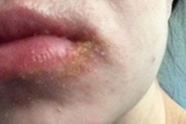 Cuidado!! Esta marca popular de bálsamo labial está a deixar várias mulheres com graves danos!