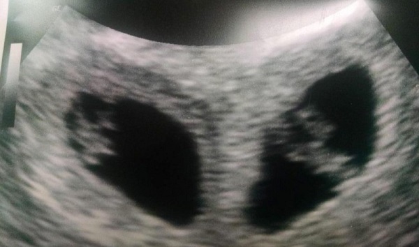 Esta grávida ficou chocada quando viu a sua ecografia…nem a médica tinha visto algo assim antes!