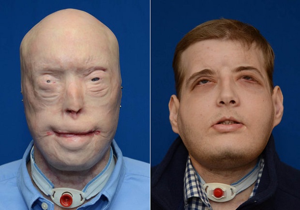 Este é o bombeiro que fez o maior transplante de rosto alguma vez realizado! Vê como está hoje!
