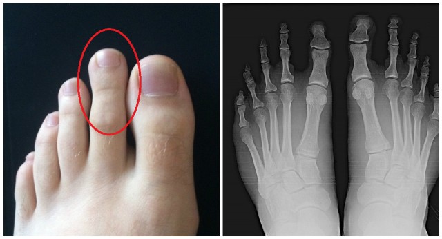 Olha para os teus dedos dos pés… Este dedo é mais longo que os outros? Então és muito especial! Porque…