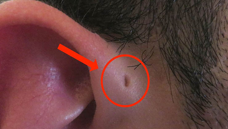 1 em cada 100 pessoas nasce com este buraco numa das orelhas! Tu tens? Sabes o que é?