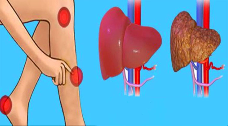 Estes são os sinais de alerta de que o teu fígado está intoxicado! É muito importante que os conheças!