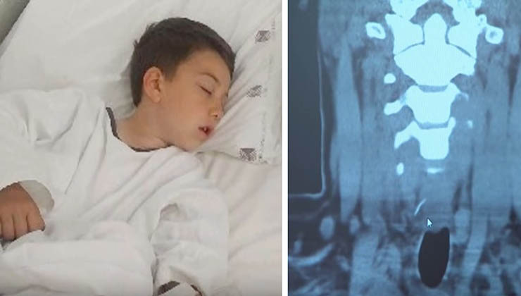 Esta criança sentiu uma enorme dor de estômago após comer um hambúrguer… No hospital os médicos descobriram o impensável!