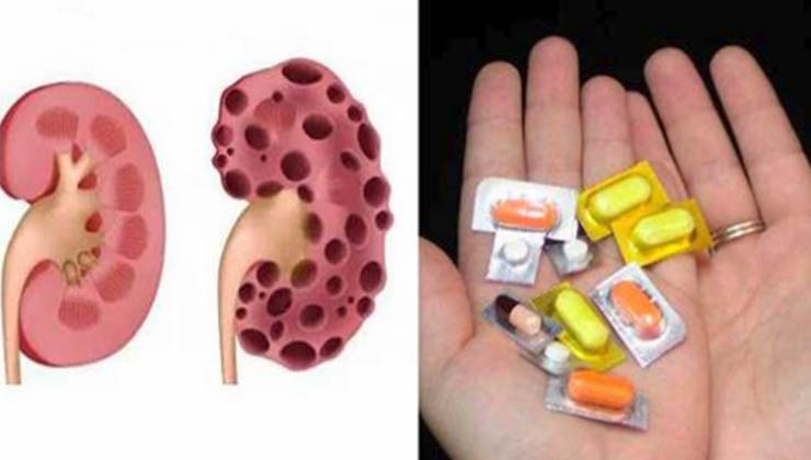 Estes medicamentos prejudicam os teus rins e os médicos estão sempre a receitá-los! Quase ninguém imagina o mal que eles fazem!