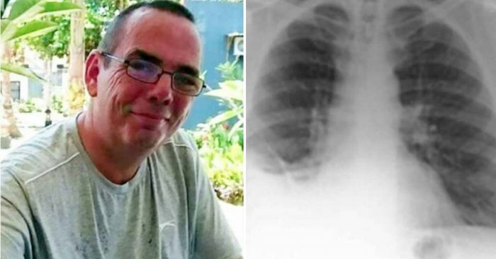 Diagnosticaram este homem com cancro no pulmão, mas quando o operaram algo estranho estava no pulmão